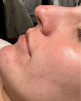 Close-up of a person's face with visible skin texture and pores.